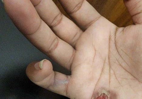 Jeri's pinky is crippled and has blister on her palm